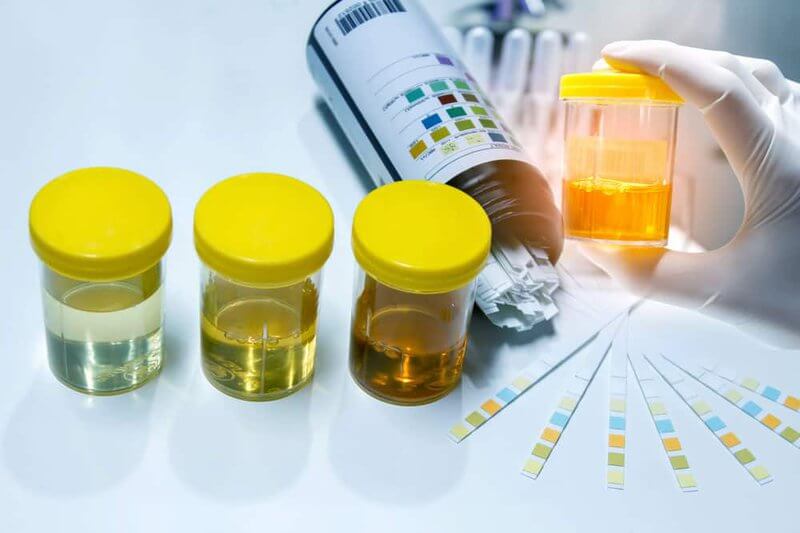 Your urine sample will examine for infections, signs of blood, and other anomalies.