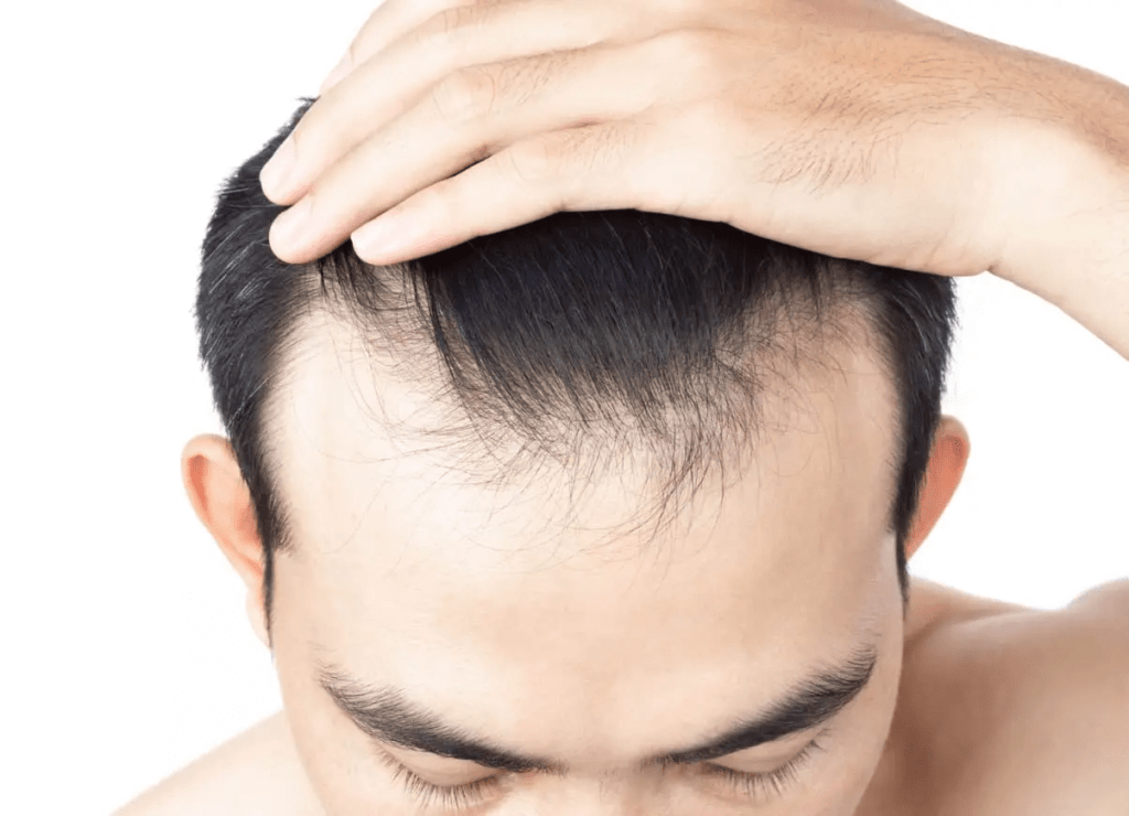 In this blog, we will outline six ways Profollica can prevent your hair follicles from harmful DHT, keeping your hair healthy and voluminous.