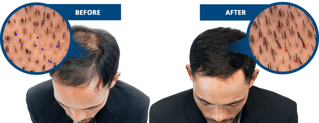 Learn how to protect your hair follicles from the damaging effects of DHT.