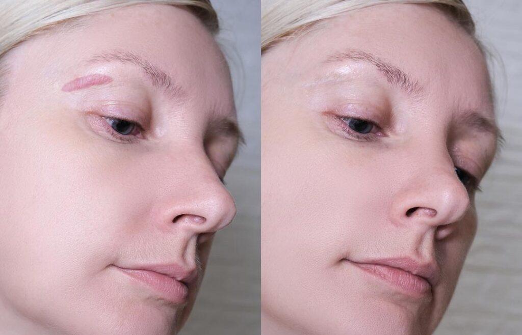 Scar Healing: How Quickly Can You Expect Scars To Disappear?