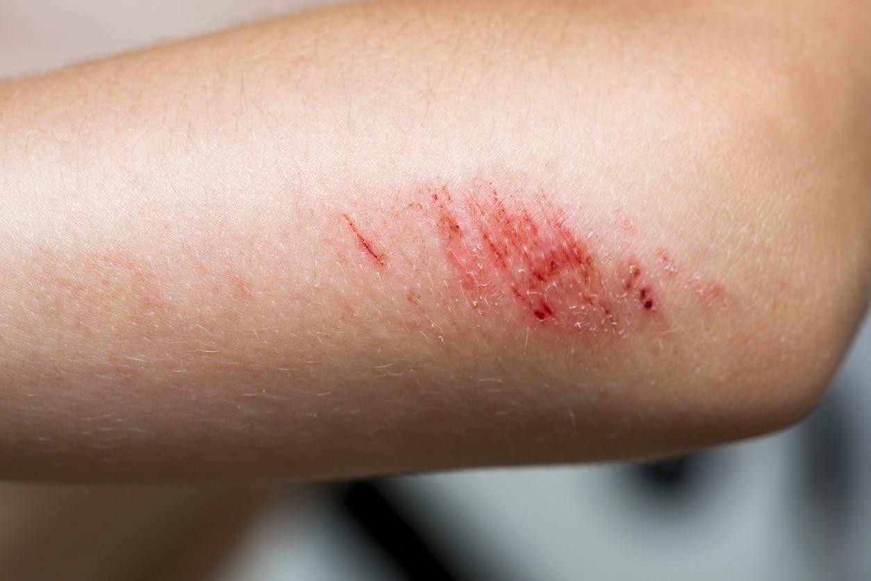 Skin Injury: How To Treat And Restore Damaged Skin