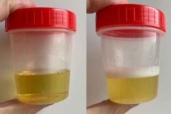 Examining The Causes Of Foamy Urine In More Detail